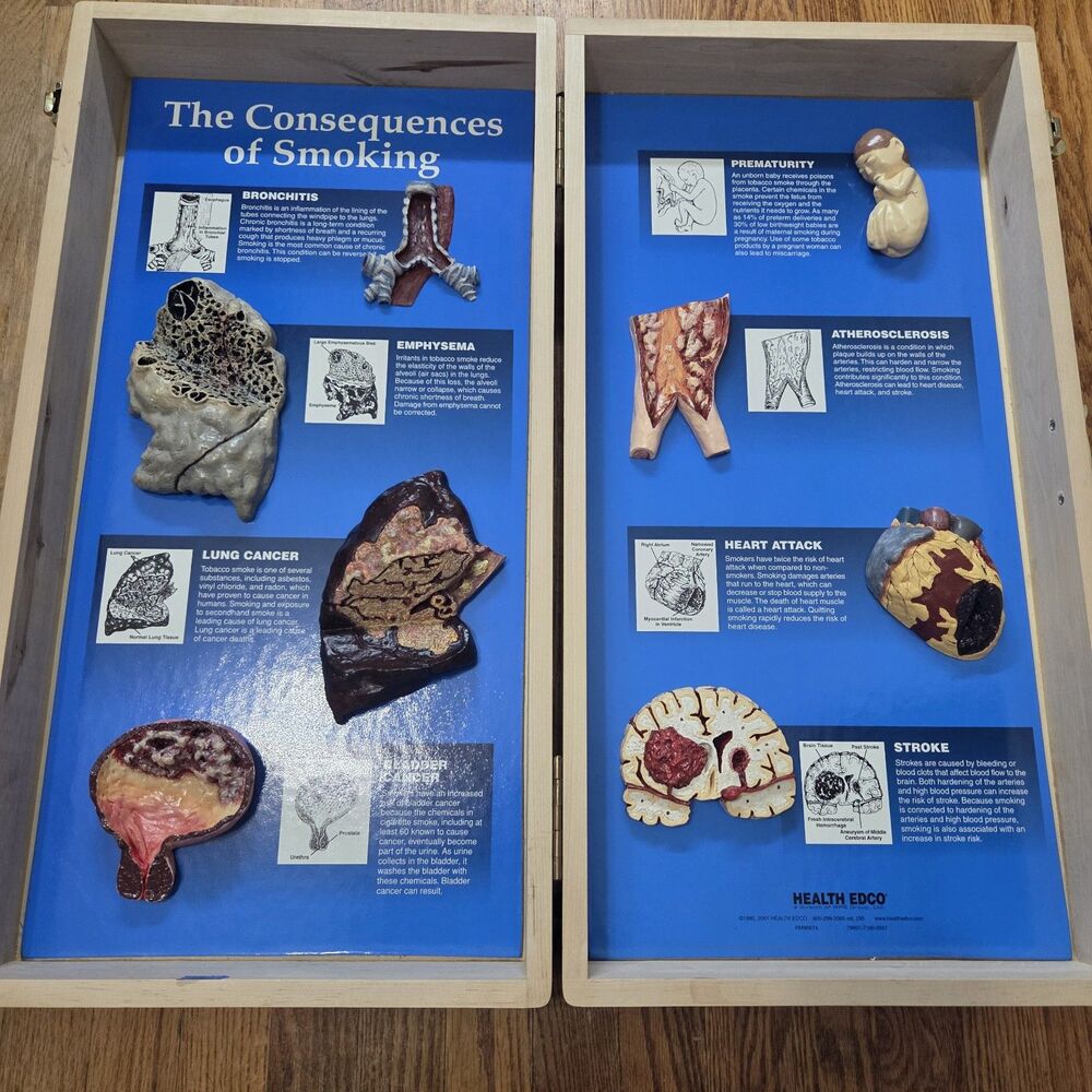 Health Edco Consequences of Smoking 3D Medical Education Display Models Case